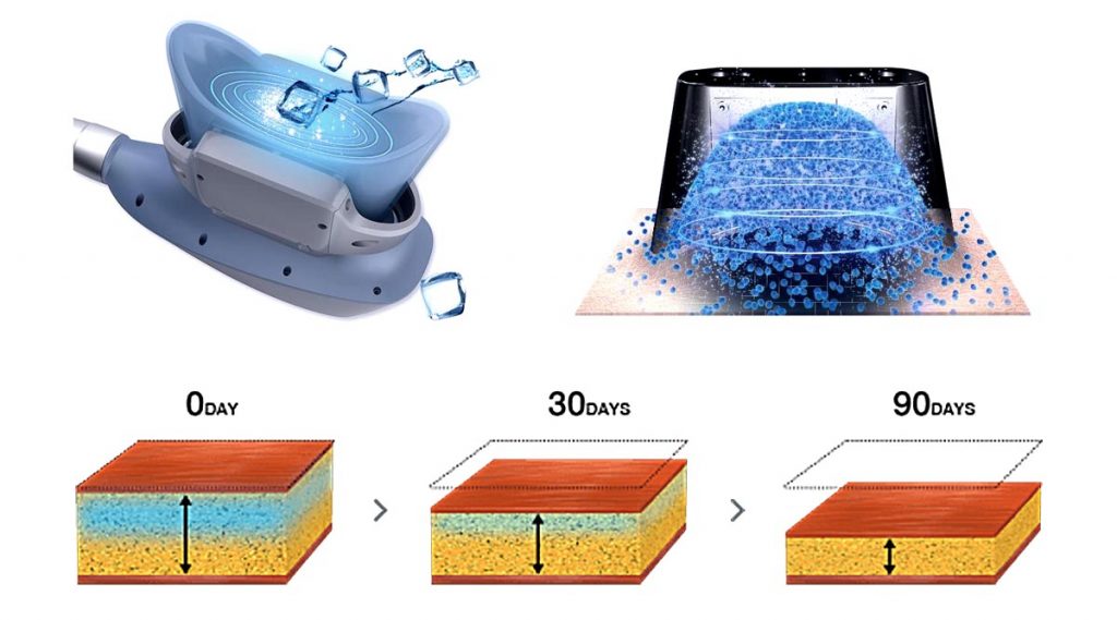Benefits of Clatuu Fat Freezing Treatment