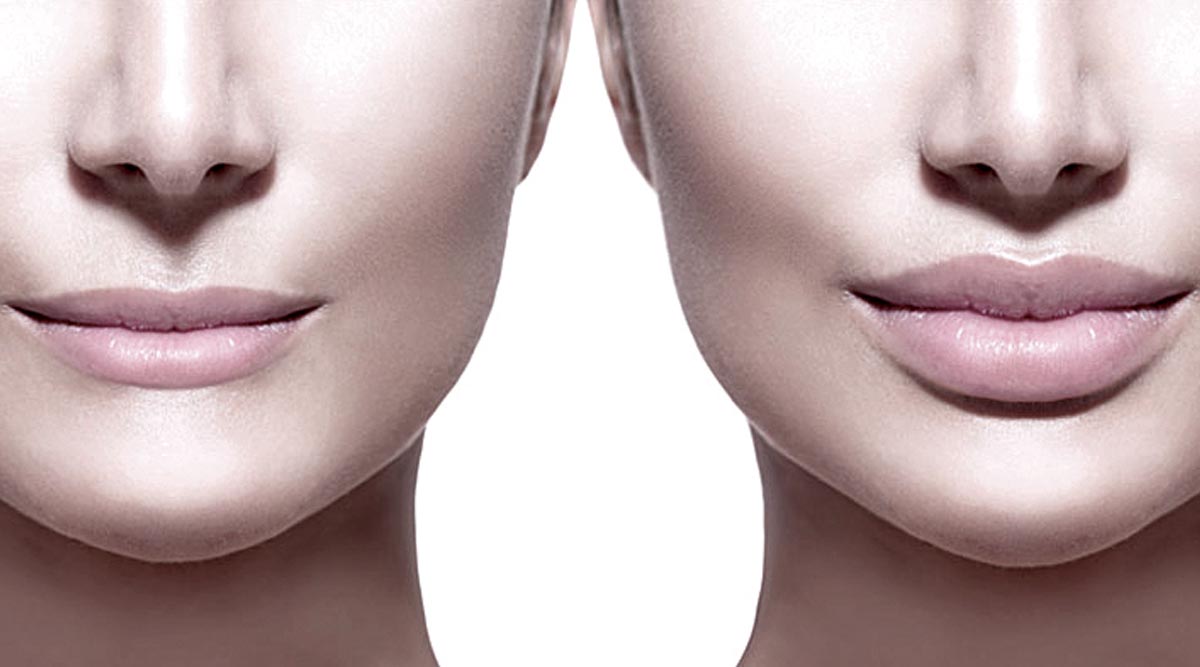 What is Dermal Filler