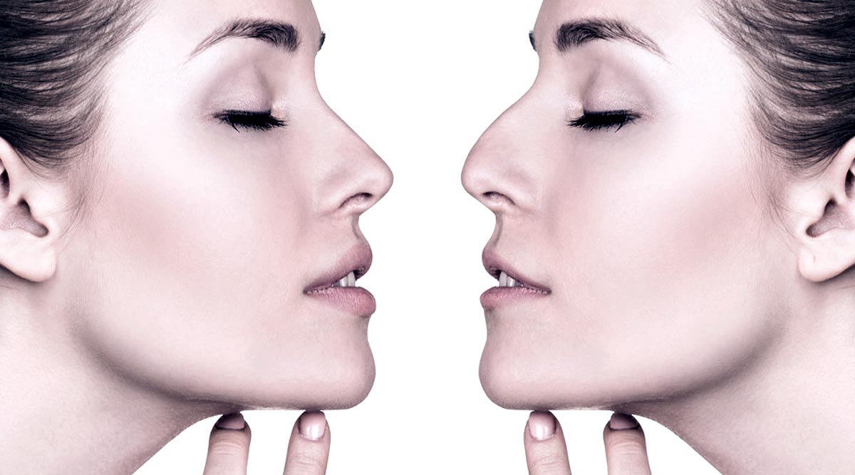 What is Dermal Filler