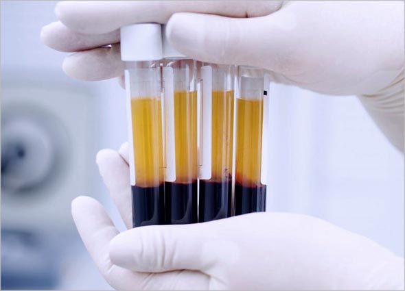 Platelet-rich Plasma