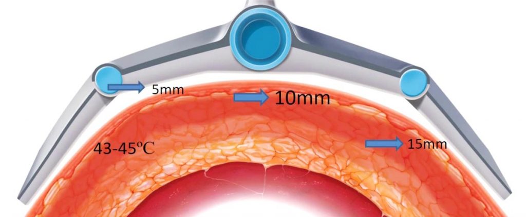 What is Vanquish Fat Reduction Treatment