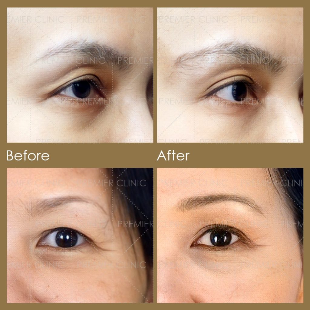 Comparing results of anti-aging skin booster treatment at Premier Clinic, Malaysia