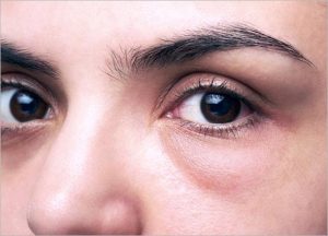 eye bags and dark eye circles