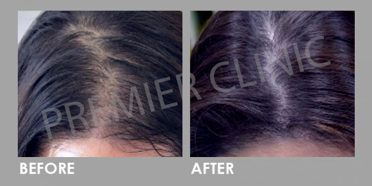 Platelet-rich Plasma (PRP)