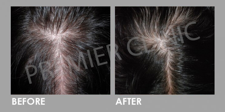Before & After Hair Filler Gel - Hair Treatment