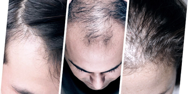 hairloss condition
