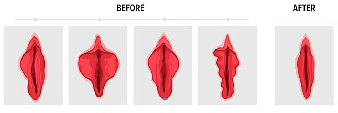 Laser Vaginal Rejuvenation