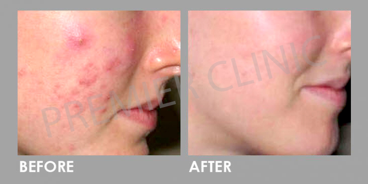 Before & After Microdermabrasion Facial Treatment