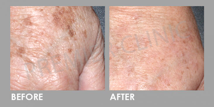 Before & After Q-Switch Nd:YAG Laser