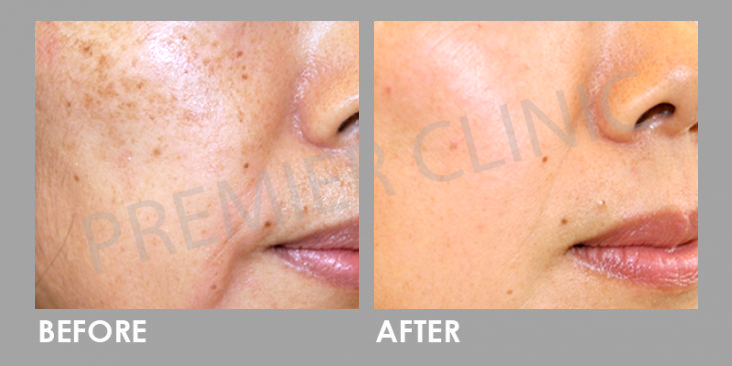 Before & After Crystal Tomato Supplement
