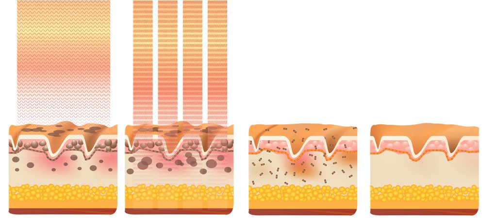 What is Q-switch Nd: YAG Laser