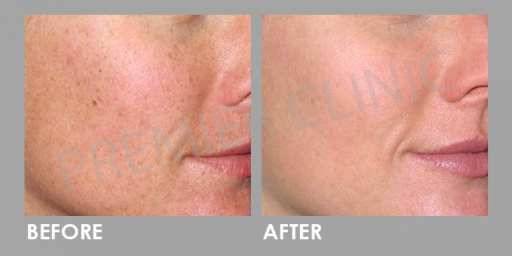 Before & After Multi Vitamin Cocktail Injection