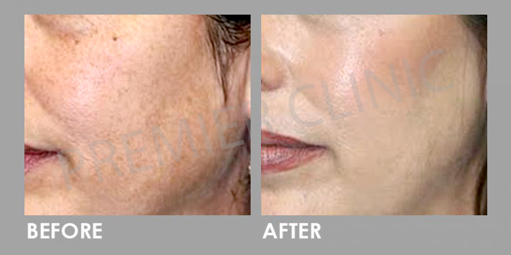 Before & After Multi Vitamin Cocktail Injection
