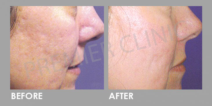 Before & After Multi Vitamin Cocktail Injection