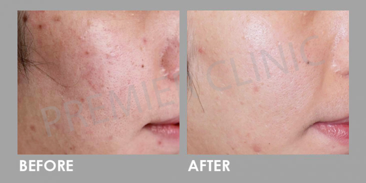 Before & After Multi Vitamin Cocktail Injection