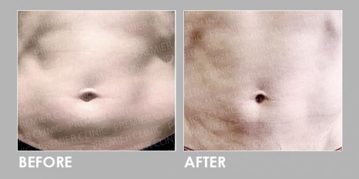 Before & After ONDA Coolwaves