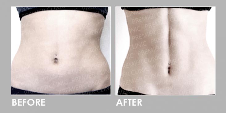 Before & After ONDA Coolwaves