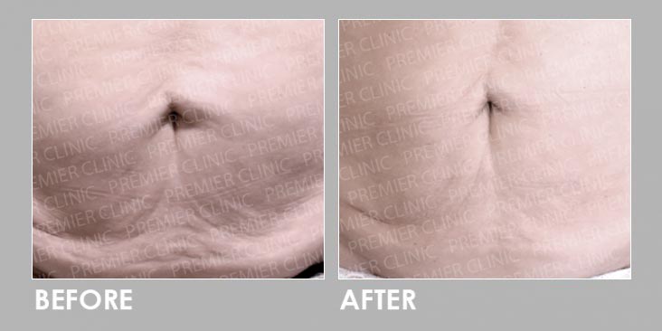 Before & After ONDA Coolwaves