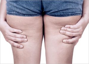 Cellulite
