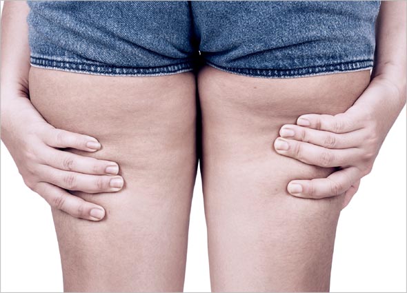 Cellulite