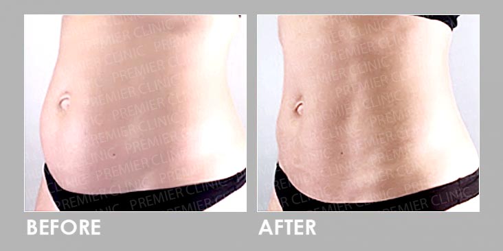 FMS Before After