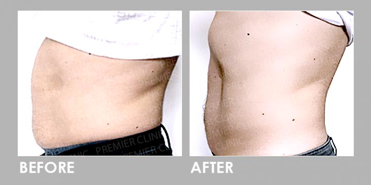 FMS Before After