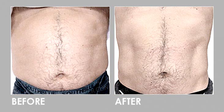 FMS Before After