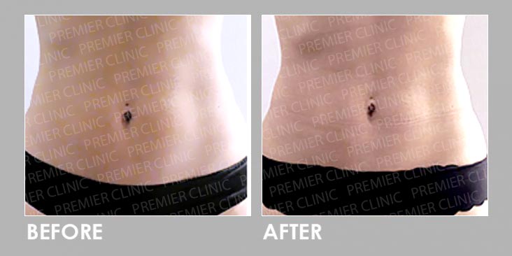 FMS Before After