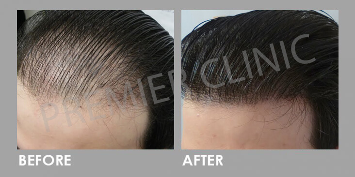 Premier Signature Hair Growth Laser Before After 03