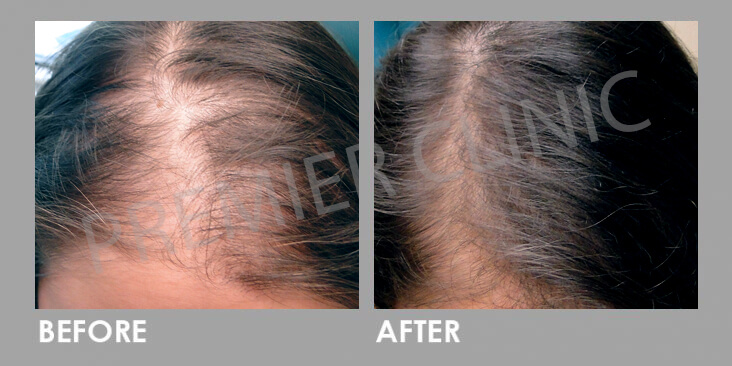 Premier Signature Hair Growth Laser Before After 02