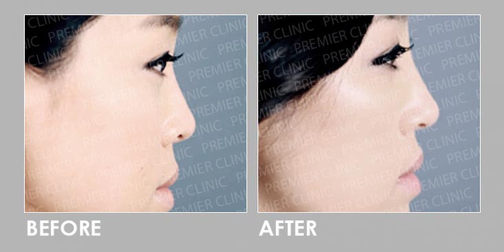 Before & After InnoPlus+