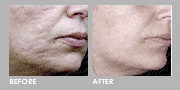 Before & After InnoPlus+