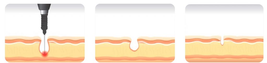 InnoPlus+ Treatment