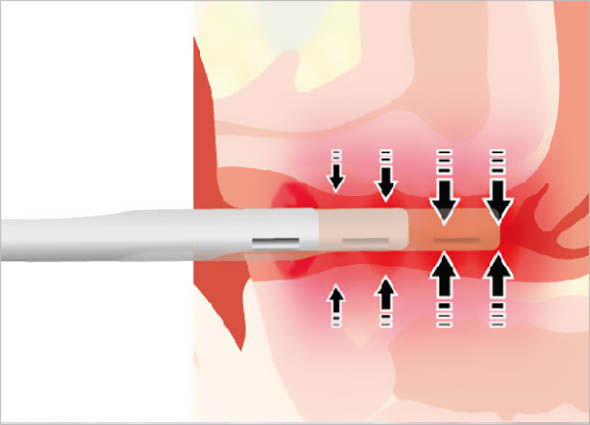 InnoPlus+ Treatment