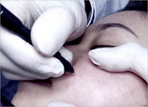 InnoPlus+ Treatment