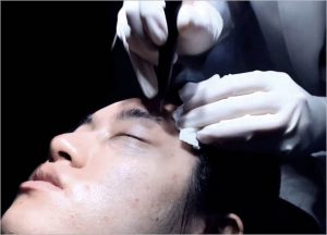 InnoPlus+ Treatment