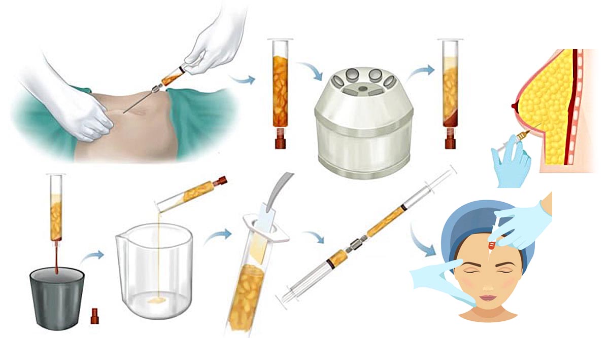 LipoCell Body Reshaping