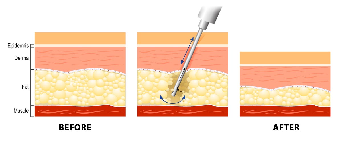 LipoCell Body Reshaping