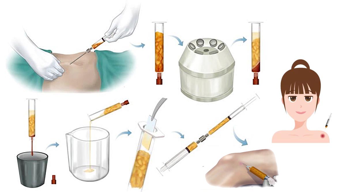 LipoCell Stem Cell 