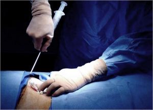 LipoCell Body Reshaping