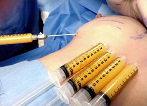 LipoCell Stem Cell