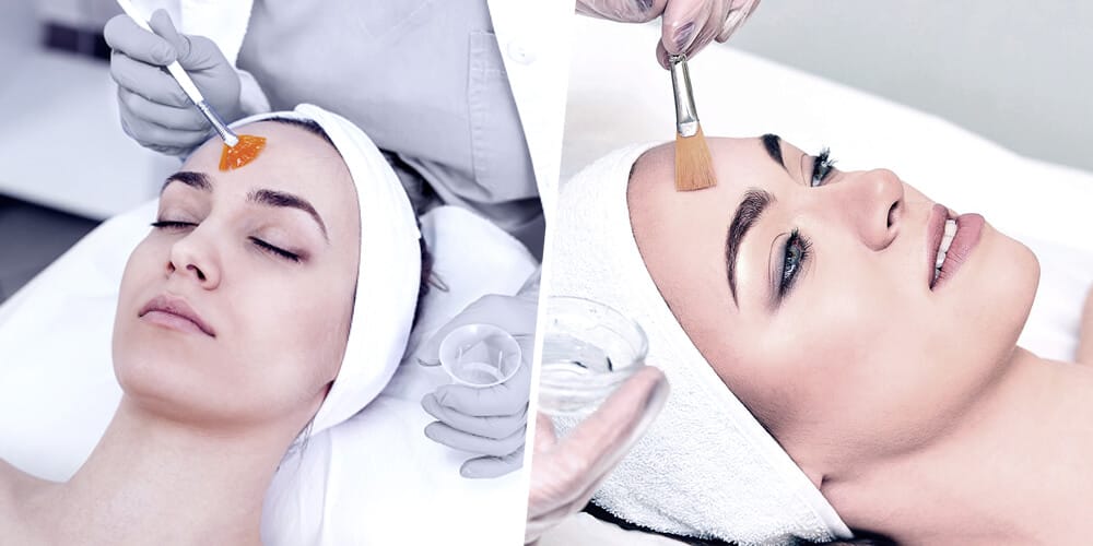 Chemical Peel for Skin Whitening