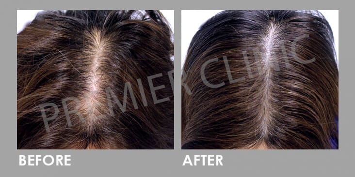 FUE Hair Transplant Before After 01