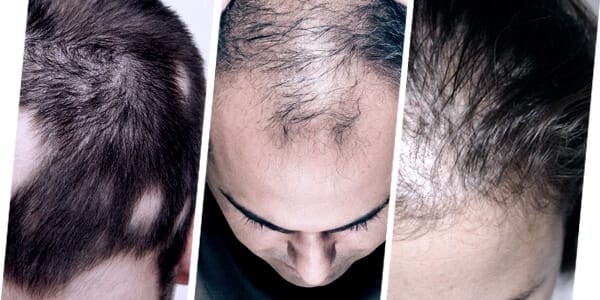 HAIR PRP IS SUITABLE TO TREAT