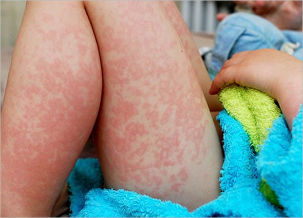 How Mold Can Affect Your Health