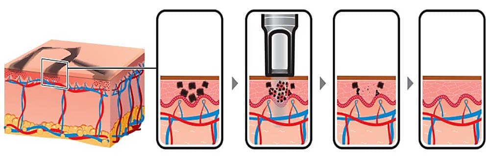 How Pico Laser Works