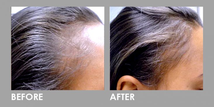 Before & After Premier LED Phototherapy