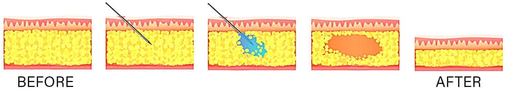 Mesolipo Injection