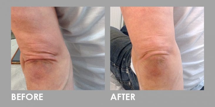 Before & After Thread Lift: Non-surgical Skin Lift