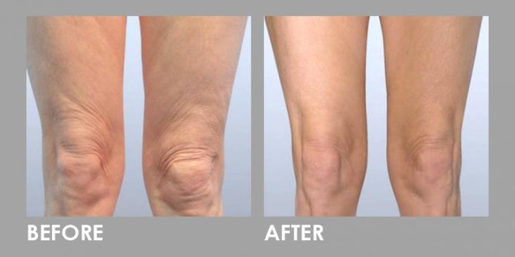 Before & After Thread Lift: Non-surgical Skin Lift